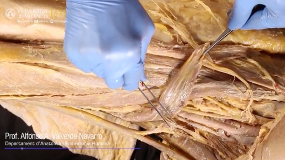 Canal Dissecció