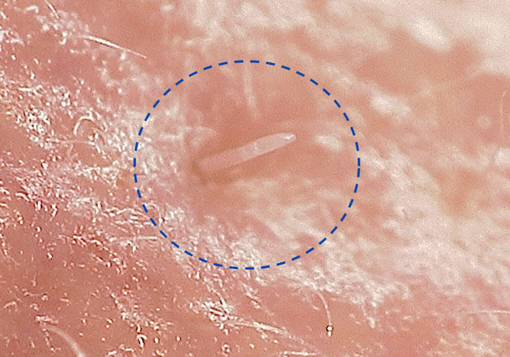 Piel con el ácaro <i>Demodex folliculorum</i>.