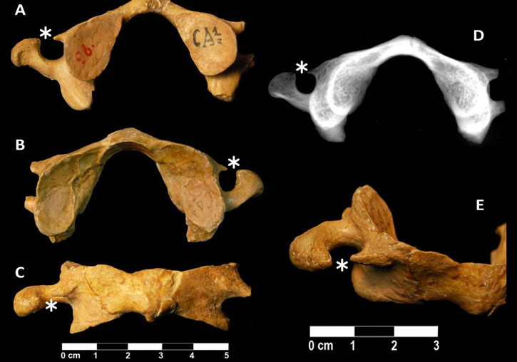 Peu de foto: Atles (Kr.98) recuperat del jaciment de Krapina que presenta la variant anatòmica coneguda com Unclosed Transverse Foramen