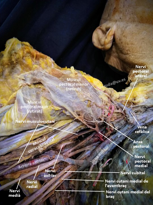 Dissecció del plexe braquial Dissecció del plexe braquial