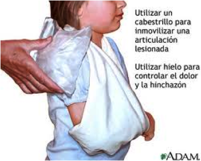 Actuación ante una fractura