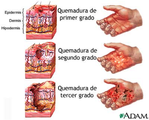 Clasificación de las quemaduras