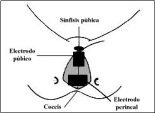 Electroestimulador para incontinencia