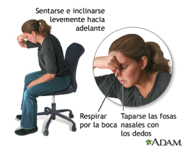Actuación ante la hemorragia nasal