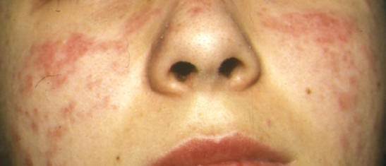 Lesiones de lupus eritematoso cutneo agudo (rash malar)