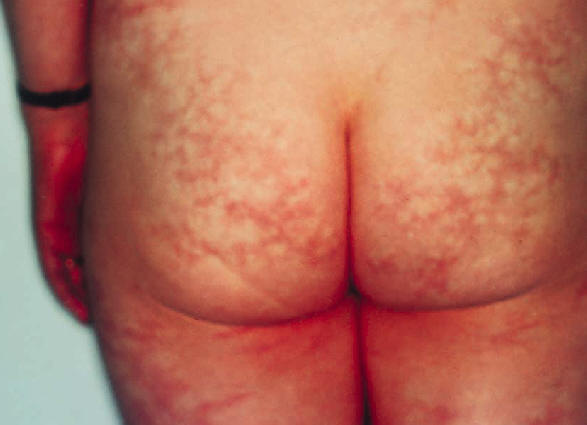 Livedo reticularis en el contexto de un sndrome antifosfolpidos secundario a lupus eritematoso sistmico.  Frances C. Piette JC. antiphospholipid antibody syndrome. Frances C, Piette JC. Dermatol Therapy, 2001, 14: 117.