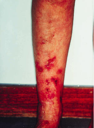 Ulceras  a tipo vasculitis livedoide co areas pigmentadas y cicatrices atrfics en un sndrome antifosfolpidos primario. Frances C, Piette JC. Dermatol Therapy, 2001, 14: 117.