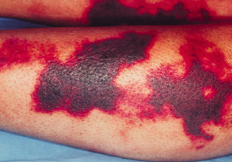 Necrosis cutnea superficial extensa en un sndrome antifosfolpidos secundario a lupus eritematoso sistmico. Frances C, Piette JC. Dermatol Therapy, 2001, 14: 117.