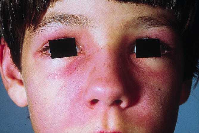 Rash heliotropo periorbital caracterstico de la dermatomiositis. Trueb RM. Dermatomyositis. Dermatologic therapy 2001, 14:70.