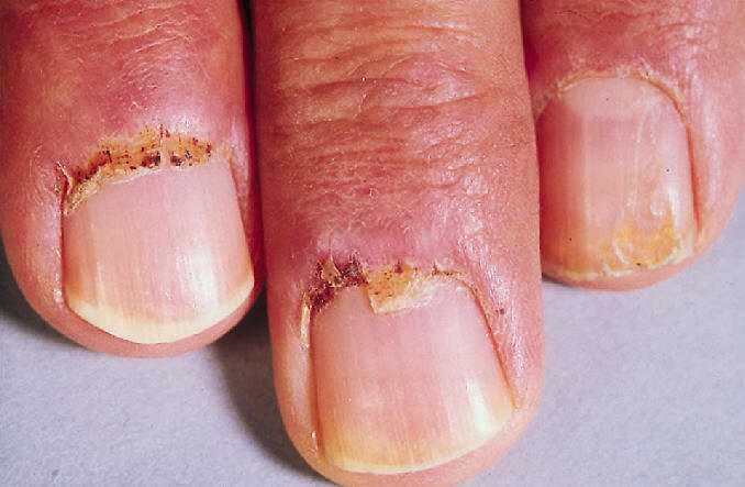 Cambios cuticulares en la dermatomiositis con cutculas engrosadas, eritema y telangiectasias.Trueb RM. Dermatomyositis. Dermatologic therapy 2001, 14:70.