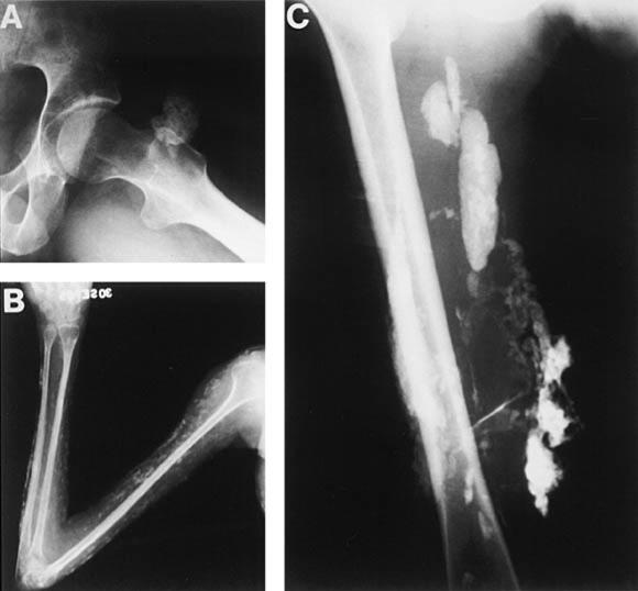 calcificaciones cutaneas en dermatomiositis juvenil que pueden adoptar varios patrones  A: tumoral, B: superficia, C: intramuscular y del exoesqueleto.  e Kovacs S, Kovacs S. Dermatomiositis. JAm Acad Dermatol 1998, 39:899