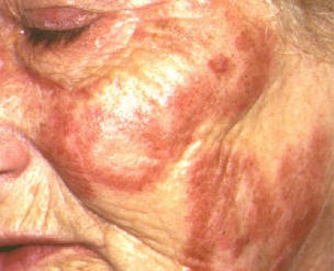 Lupus eritematoso cutneo subagudo