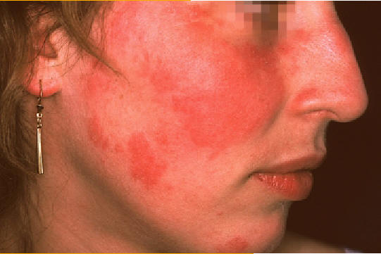 Lupus eritematoso cutneo agudo. Rash malar. La erupcin se caracteriza por mculas y plaas eritemato edematosas, sin atrofia ni queratosis folicular afectando a ambos pomulos con distribucin en "alas de mariposa". Lachapelle JM: Atlas of Dermatology. UCB pharmaceuticals