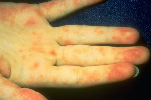 Lesiones cutneas de vasculitis leucocitoclstica en una paciente de 13 aos con lupus eritematoso sistmico y glomerulonefritis severa. NLTDS on CDrom. AAD.