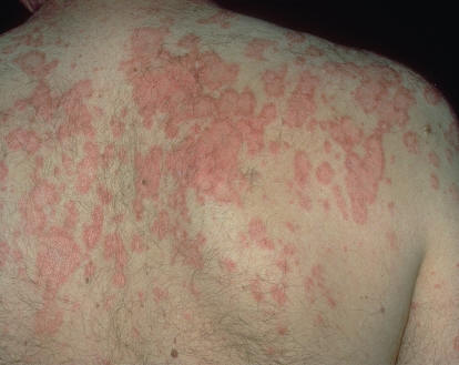 Lupus eritematoso cutneo subagudo. Lesiones papuloescamosas. NLTDS on CDrom. AAD.