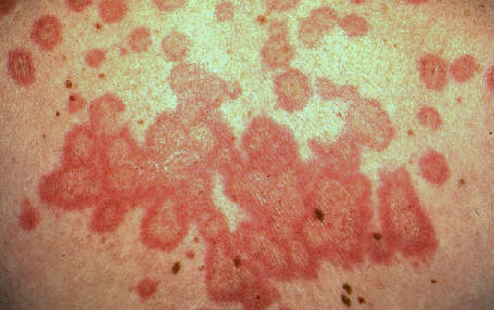 Lupus eritematoso cutneo subagudo