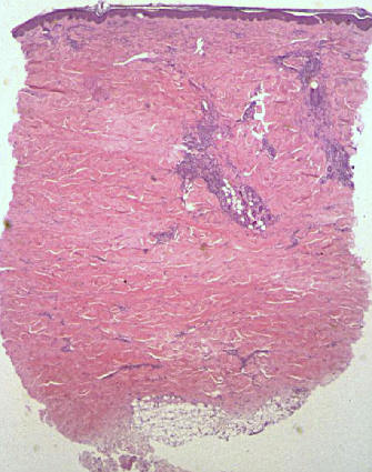 biopsia cutnea de una placa de morfea, mostrando la atrofia epidermica, con disminucin de las crestas epidermicas interpapilares, disminucin del nmero y tamao de estructuras anexiales, presencia de infiltrado inflamatorio de predominio linfoctico y marcado engrosamiento del colgeno dermico que confiere a la biopsia una morfologa cuadrada.