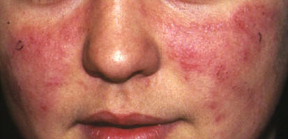 Lupus cutneo agudo