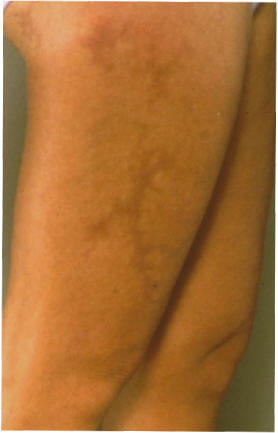 Livedo reticulares asociado a anticoagulante lpico (sindrome de anticuerpos antifosfolpido)