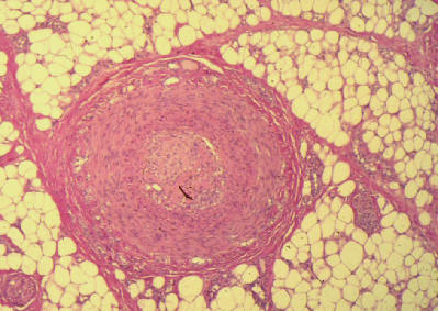 Trombosis no inflamatoria de vasos subcutneos asociados a anticogulante lpico (sindrome de anticuerpos antifosfolpido)