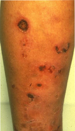 Ulceras cutneas superficiales asociadas a anticoagulante lpico