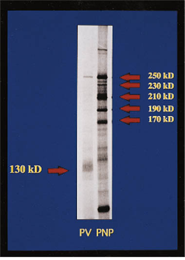  Hossein C. Nousari, MD. J Am Acad Dermatol 1999;40:750-4.