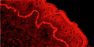 Gohestani RF. Bullous pemphigoid: from the bedside to the research laboratory. Clinics Dermatol 2001:19:690-6