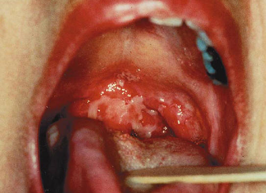 Ghohtestani RF. Color atlas:autoimmune blistering skin diseases. Clin Dermatolo 2001;19:642