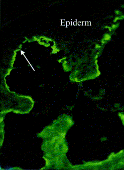 Gohestani RF. Bullous pemphigoid: from the bedside to the research laboratory. Clinics Dermatol 2001:19:690-6