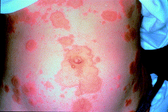 Mong-Shang L. Herpes Gestationis- Clinics in Dermatology 2001, 19:697