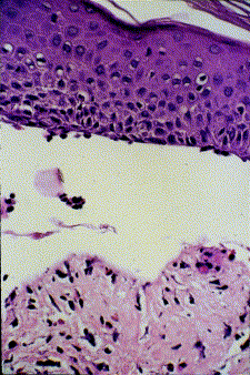 Mong-Shang L. Herpes Gestationis- Clinics in Dermatology 2001, 19:697