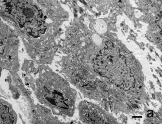 Ishiko A. Electron mycroscopy in diagnosis of autoimmune bullous disordes. Clinics in Dermatol 2001, 19:631
