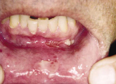 Ghohtestani RF. Color atlas:autoimmune blistering skin diseases. Clin Dermatolo 2001;19:642