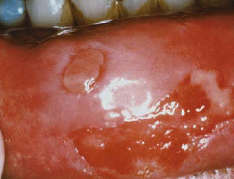 Penfigoide de mucosas. Lesiones eriosivas en mucosa labial.Nousari HC. Autoimmune bullous disease.  in Provost T. ed Cutaneous medicine. BC Decker Hamilton 2001.