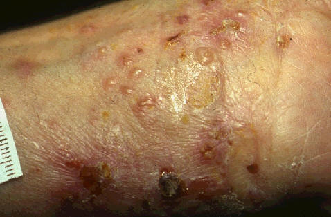 Penfigoide ampolloso. Multiples lesiones vesiculo-ampollosas en brazos