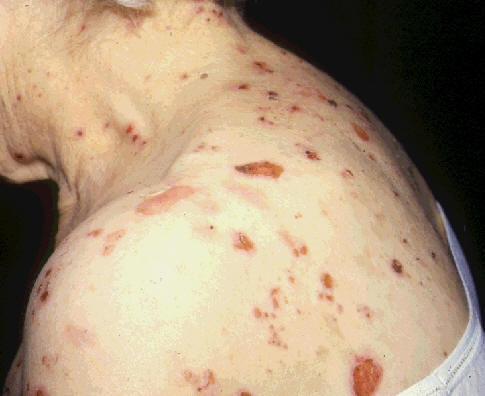 Penfigoide ampolloso. Lesiones ampollosas rotas por el rascado