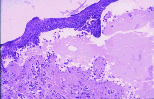 Penfigoide ampolloso. ampolla subepidermica con infiltrado inflamatorio con polimorfonucleares neutrofilos y eosinofilos