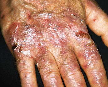 Epidermolisis ampollosa adquirida (NLTS2)