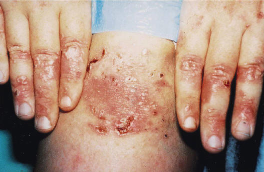 Epidermolisis ampollosa adquirida ( atlas de enfermedades ampollosas)