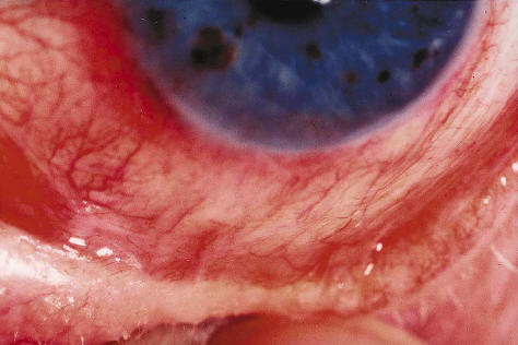 Ghohtestani RF. Color atlas:autoimmune blistering skin diseases. Clin Dermatolo 2001;19:642