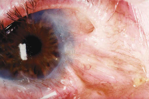 Ghohtestani RF. Color atlas:autoimmune blistering skin diseases. Clin Dermatolo 2001;19:642