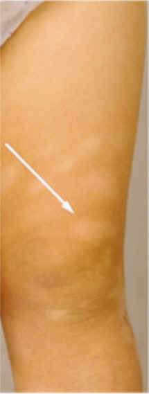 imagen de pitiriasis alba (SCORAD)