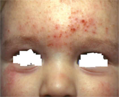 dermatitis en frente