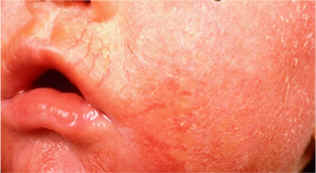 dermatitis aguda (imagen SCORAD)