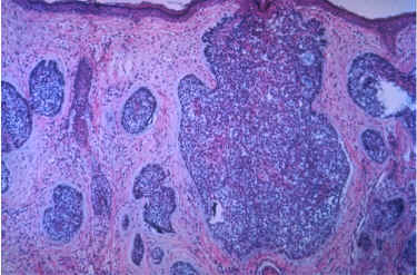 imagen histolgica del carcinoma basocelular (AAD)