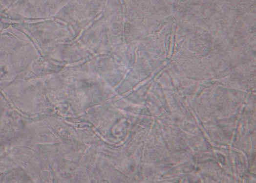 El examen directo del exudado blanquecino de la superficie mostr la presencia de pseudohifas tabicadas caractersticas de la infeccin por cndida