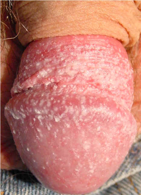 Balanopostitis candidiasica. Paciente diabtico que consulta por la presentacion de lesiones en glande consistentes en erosiones superficiales cubiertas de pustulas blanquecinas.