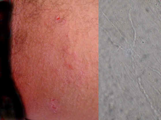 Tinea cruris. Placa eritematosa de crecimiento centrfugo y borde discretamente descamativo, con afectacin bilateral. El KOH de las escamas demostr la presencia de hifas tabicadas.