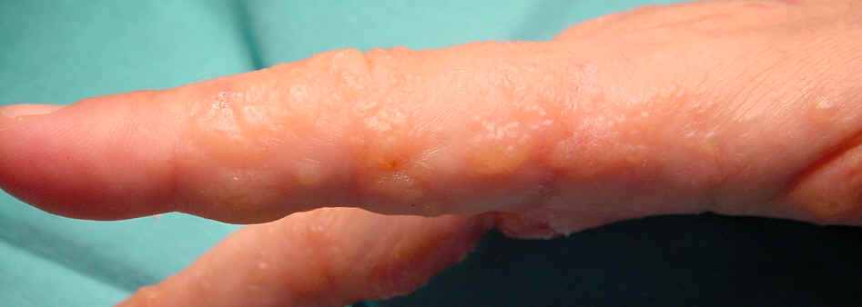 El eczema dishidrotico afectando a la cara lateral de los dedos en forma de vesculas en nmero y tamao variable es una de las reaccines inflamatorias o "ides" que se observan con mas frecuencia asociadas a las infecciones dermatofticas.
