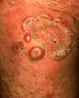 Micosis fungoide. Lachapelle JM. Atlas of dermatology. UCB.